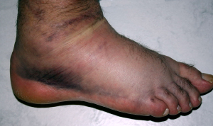 Image of ankle