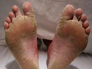 Image of Athletes foot