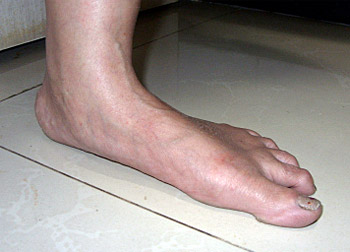 Image of flat foot
