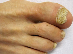 Image of Fungal Nail