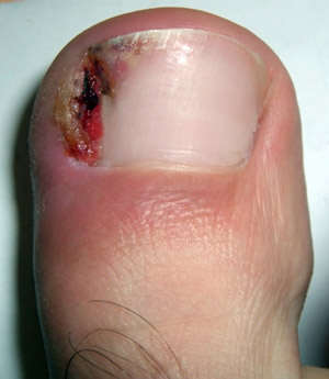Image of ingrown toenail