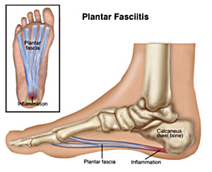 Image of Plantar Fasciitis