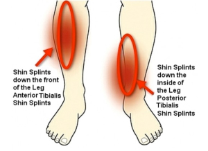 Image of shin splints